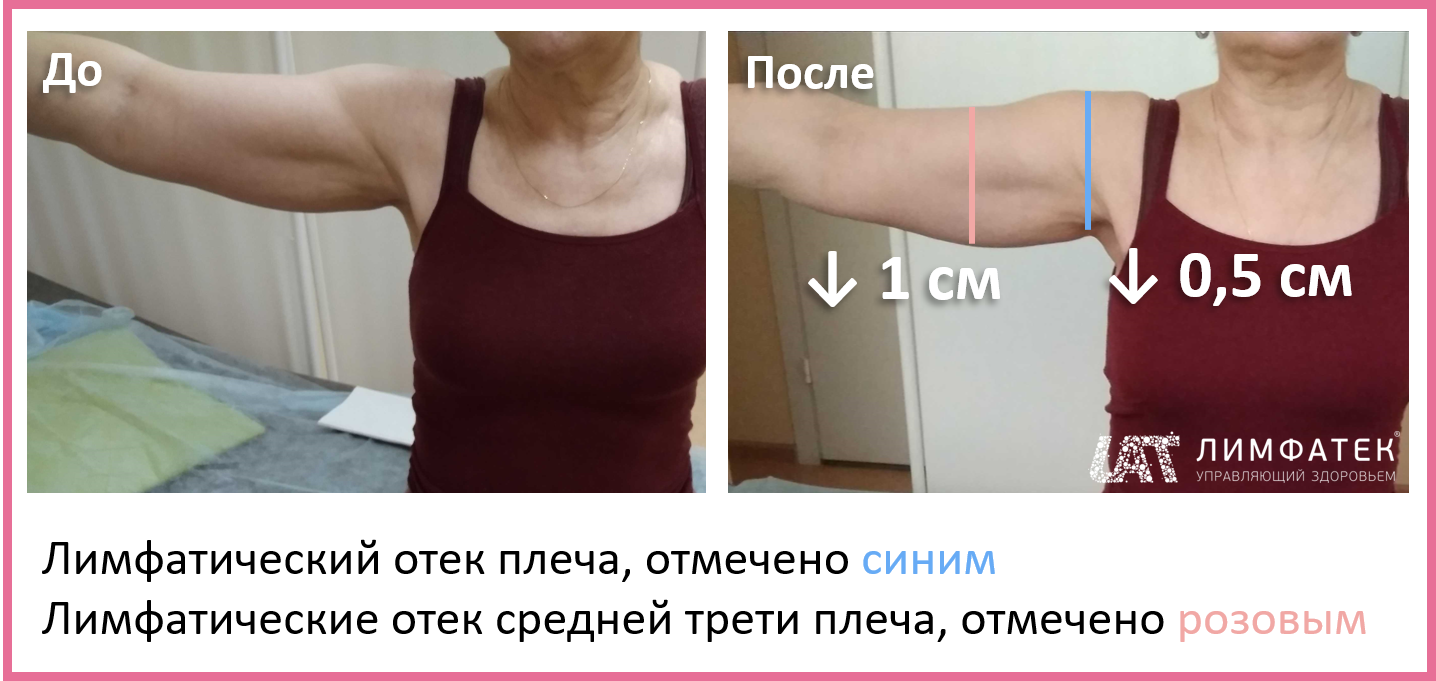 Реконструкция груди после мастэктомии - цены в Киеве, Варшаве | DR ZYKOV